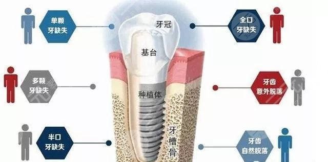 4A即得植牙 当天种植当天就用(图)