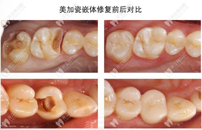 宝威体育下载网站：宝威体育官网：@云南人缺牙烂牙、牙不齐人人有优惠！这个黄金周看牙超划算！