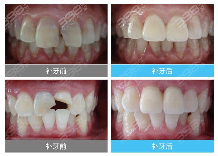当心低价陷阱！“人的第三副牙齿”种植牙究竟贵在哪、乱象有哪些？