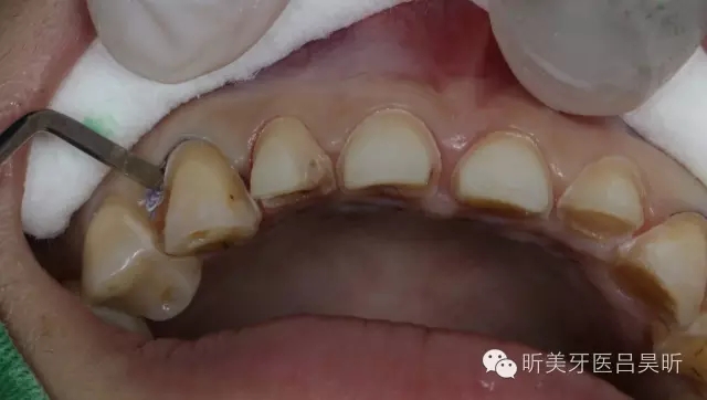 补牙后需要了解的注意事项补牙后的注意事项总结