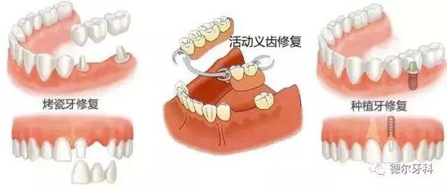 宝威体育下载网站：牙齿决定生活质量缺牙修复应趁早(图)