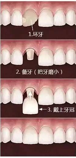 牙齿修复有什么方法