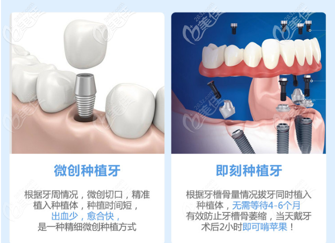 种植牙手术有几种方式？哪种技术更先进速度更快？(图1)