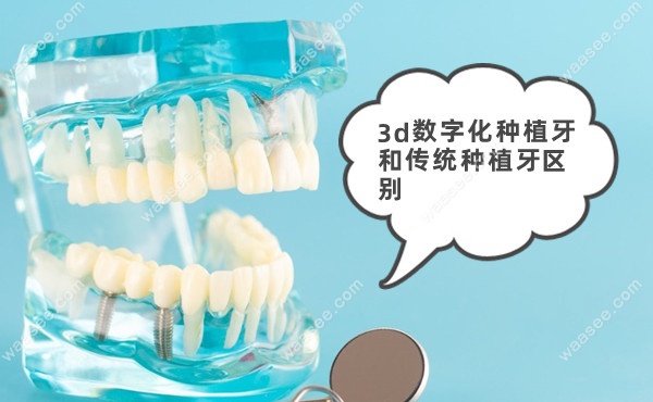 宝威体育下载网站：get3d数字化种植牙和传统种植牙区别后爸妈都选种牙新技术(图1)