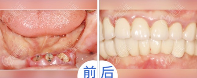 植牙是怎么回事