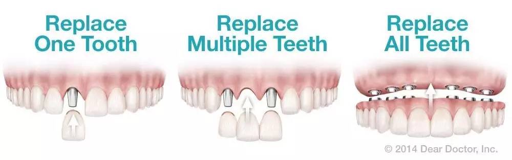 宝威体育官网：宝威体育下载网站：Dental implant│正确认识植牙技术(图2)