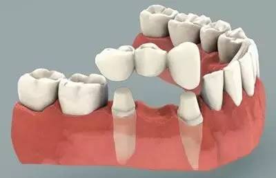 宝威体育官网：宝威体育下载网站：Dental implant│正确认识植牙技术(图4)