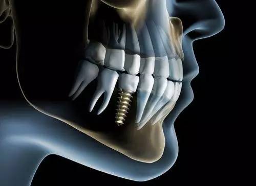 宝威体育官网：宝威体育下载网站：Dental implant│正确认识植牙技术(图6)