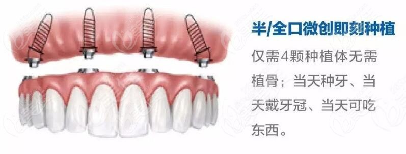 宝威体育官网：宝威体育下载网站：如何种植牙的步骤