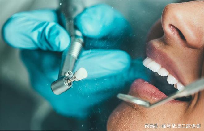 宝威体育：在廊坊牙齿修复和美容后还要做牙齿抛光！(图1)