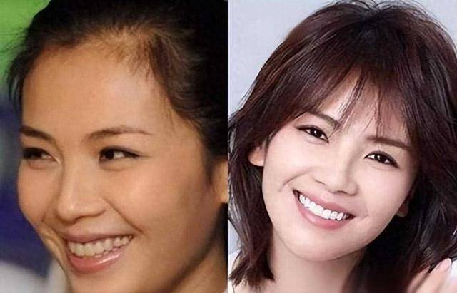 刘涛为了变美拔光牙齿一口烤瓷牙300万如今肠子悔青了(图1)