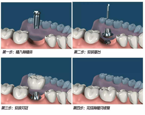 宝威体育下载网站：公开排行榜单：南京无痛全口半口种植牙医院_补一颗牙齿大概多少钱