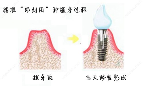 宝威体育官网：宝威体育：目前先进的种植牙技术：All-on-4即刻负重微创种牙的区别是啥(图3)