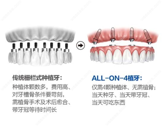 宝威体育官网：宝威体育：目前先进的种植牙技术：All-on-4即刻负重微创种牙的区别是啥(图2)