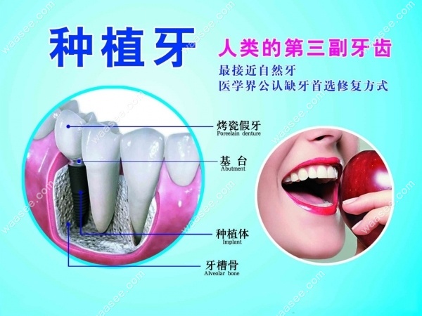 宝威体育官网：宝威体育：目前先进的种植牙技术：All-on-4即刻负重微创种牙的区别是啥(图4)