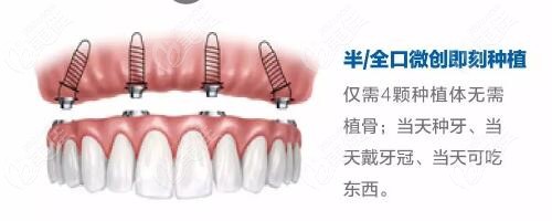 宝威体育下载网站：宝威体育官网：搞清种植牙即拔即种技术的优缺点你会选即刻还是传统种牙(图3)