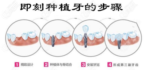 宝威体育下载网站：宝威体育官网：搞清种植牙即拔即种技术的优缺点你会选即刻还是传统种牙(图5)