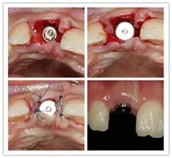 即拔即种种植牙的利与弊分析就知道种牙要不要选即刻种植技术(图2)