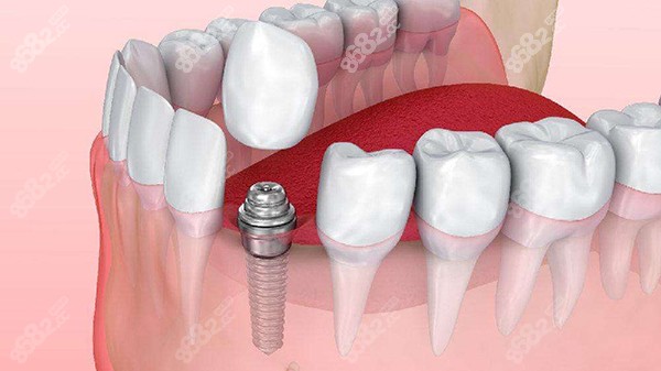 宝威体育下载网站：牙齿种植体怎么种植