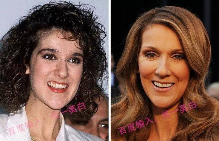 宝威体育官网：宝威体育：口腔美学-DSD美学设计-一口漂亮的牙齿少不了瓷贴面的修复！(图1)
