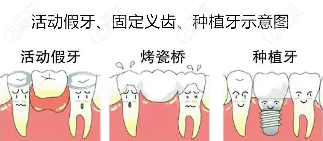 公开排行榜：武汉专业种植牙医院“精选快讯”武汉做全口种植牙哪家好