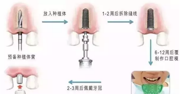 宝威体育官网：宝威体育下载网站：：种植牙技术造福中老年人巩固牙齿健康(图1)