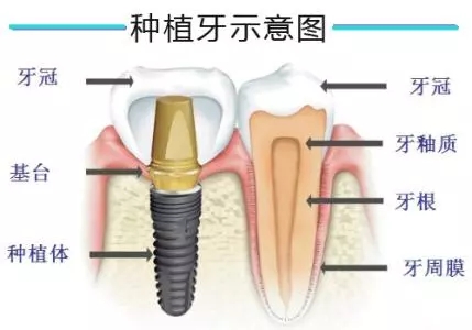种植牙齿过程详细讲解