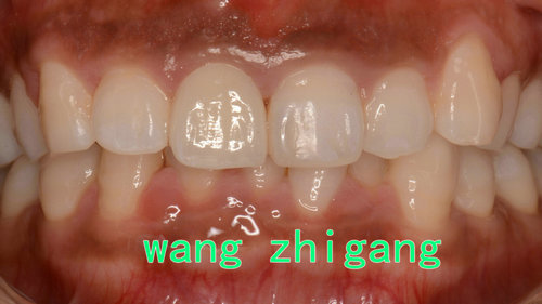 上门牙美学修复病例（一）(图2)