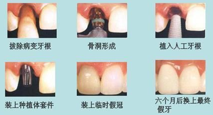 种植牙手术是怎么做的(图1)