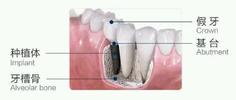 如何做到准确种牙？仅靠种植医生经验技术远远不够！