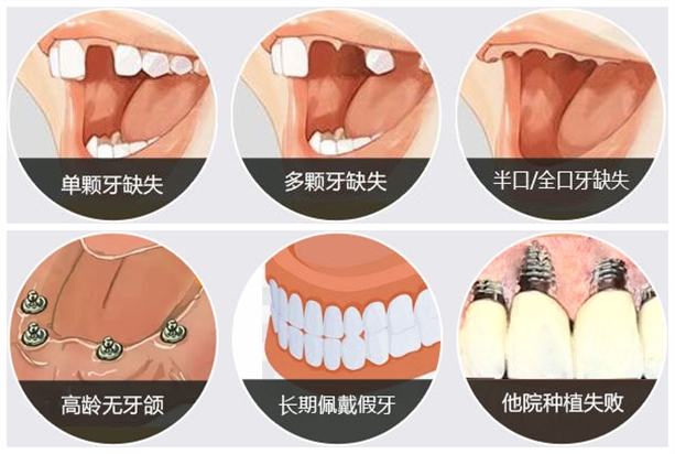 种牙的方法 - 专家文章 - 博禾医生