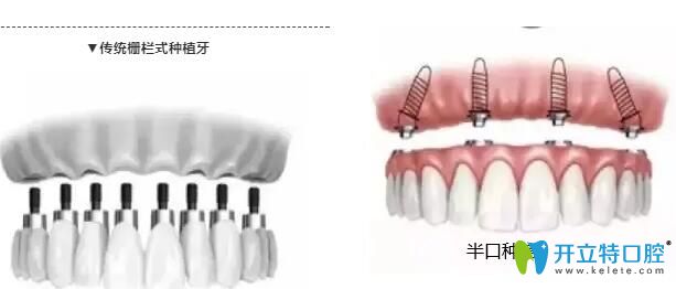 什么是牙种植_邬利波医生的语音科普_妙手医生